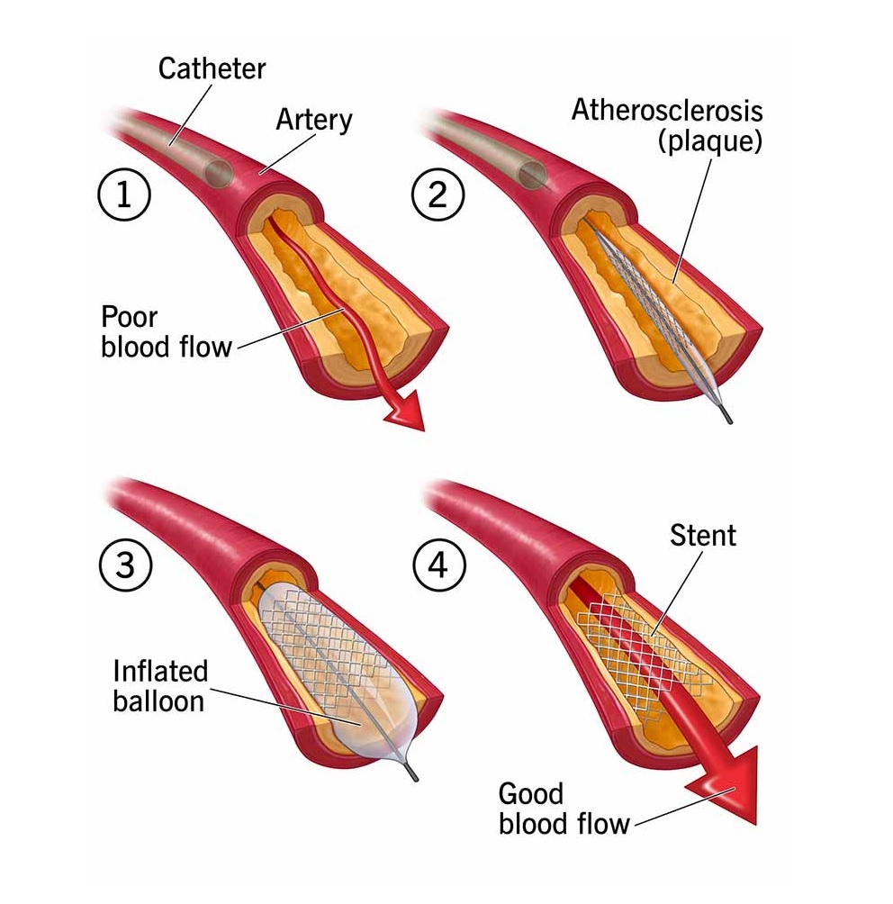 22060-balloon-angioplasty-with-stent